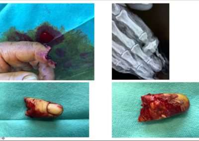 Amputation complète de l’index par scie circulaire