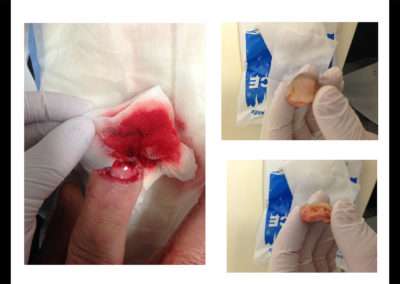 Réimplantation du 3ème doigt, mécanisme d’amputation franche par section par scie