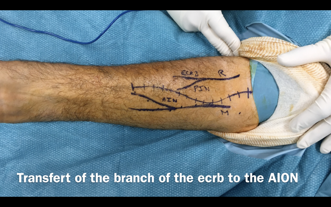 Neurotisation Radial sur Median