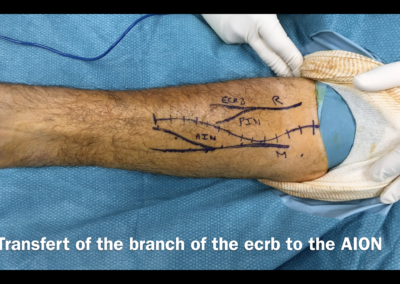 Neurotisation Radial sur Median