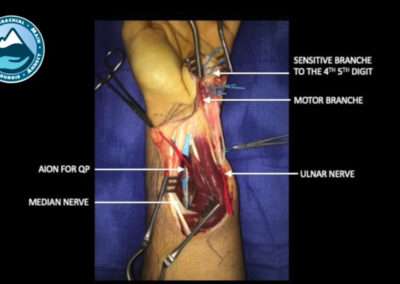 Neurotisation Median sur Ulnaire