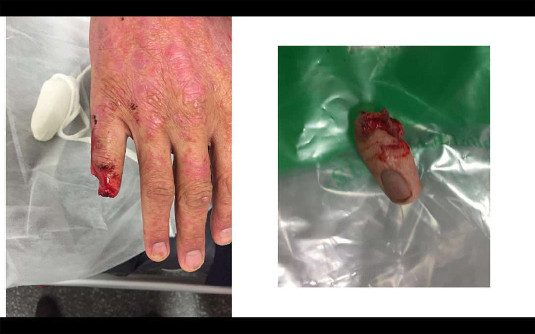 Réimplantation du 5ème doigt, mécanisme d’arrachement par bague: Ring Finger