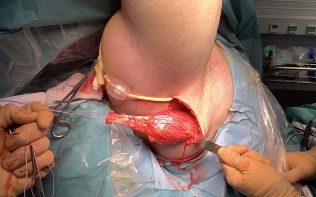 Transfert de grand dorsal sous arthroscopie pour rupture irréparable de sous scapulaire
