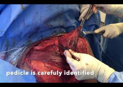 Transfert de Grand pectoral palliatif d’une paralysie du deltoïde secondaire à une neuropathie chronique du plexus brachial