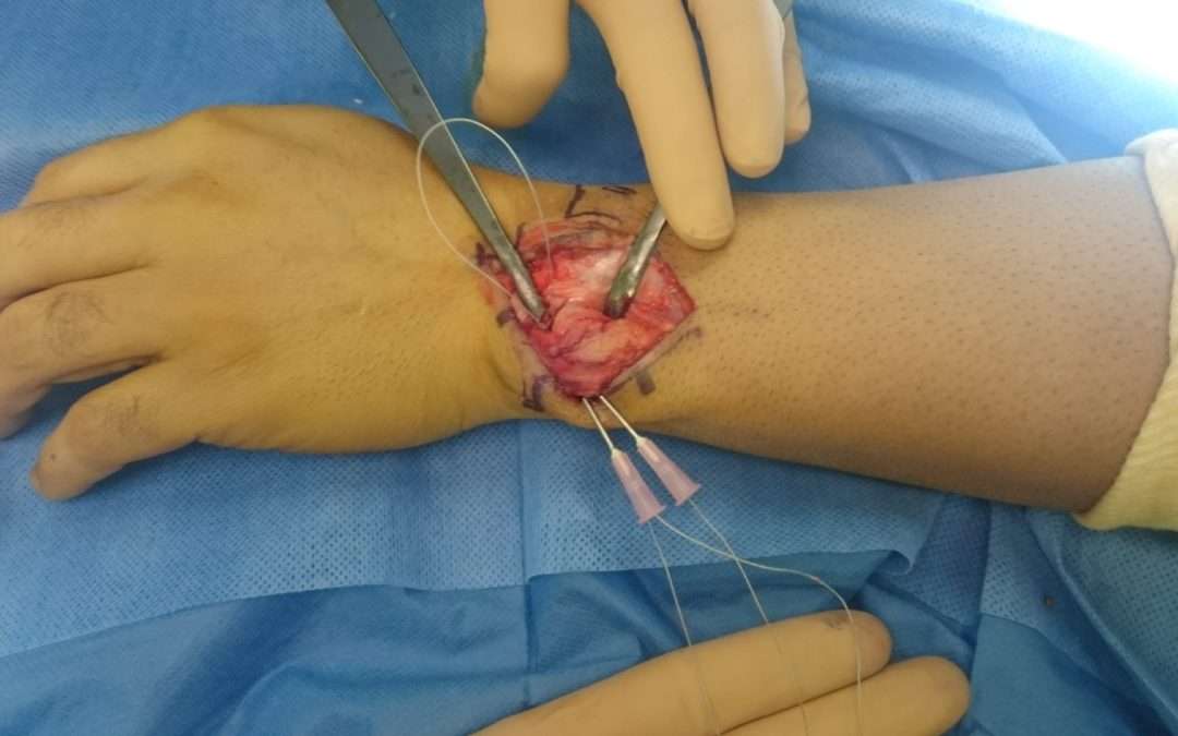 Cas Clinique – Reconstruction des ligaments extrinsèques du poignet