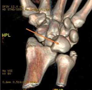 Réparation de fracture luxation rétro-lunaire du carpe