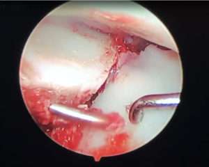 Réparation de fracture complexe intra-articulaire du radius distal (sous contrôle arthroscopique)