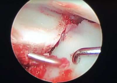 Chondromatose synoviale du coude