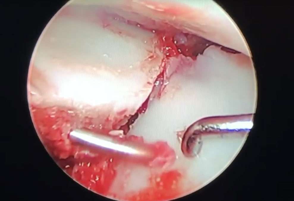 Fx Radius Distal arthro