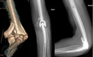 Reconstruction et/ou ostéosynthèse du coude par prothèse totale