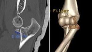 Réparation de fracture-luxation du coude avec instabilité