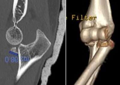 Fracture-luxation du coude