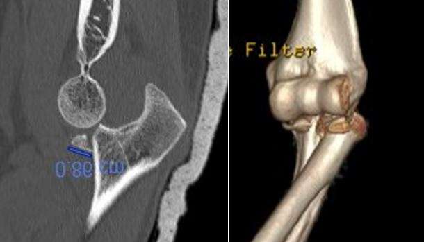 Fracture-luxation du coude