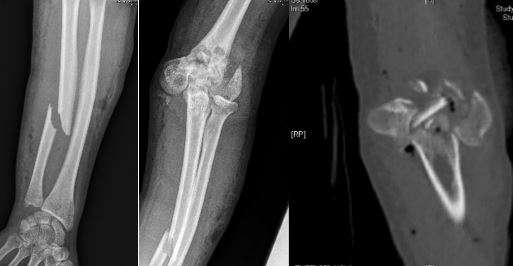 Réparation fracture comminutive coude | Plexus Brachial ...